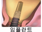임플란트