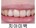 치아미백